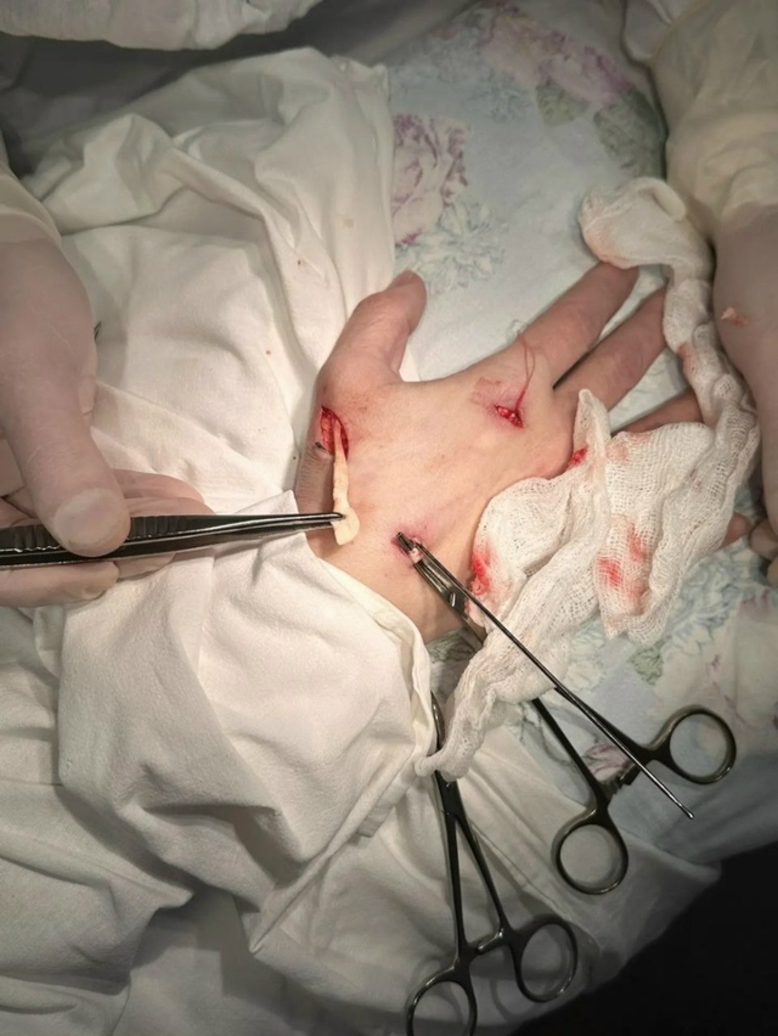 В Башкирии сделали уникальную операцию на кисти