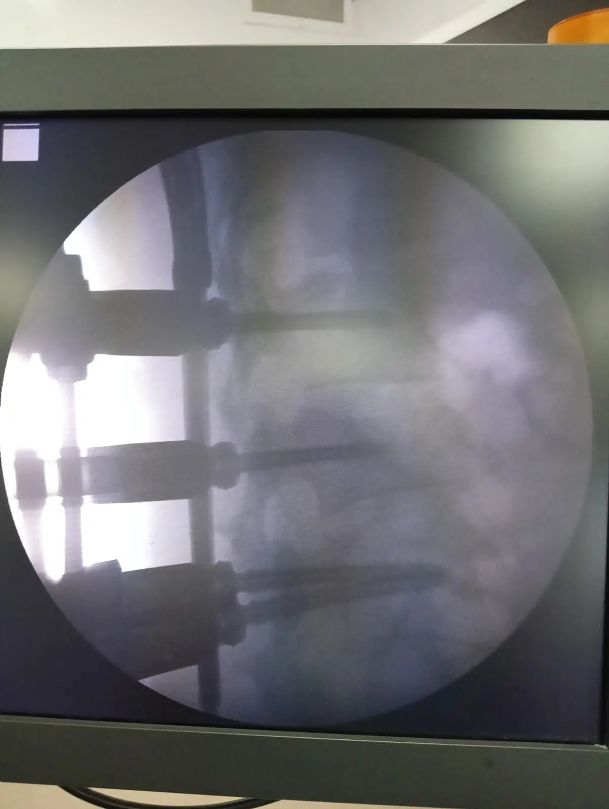 1 шәһәр хастаханәсе табиблары уникаль операция ясаган